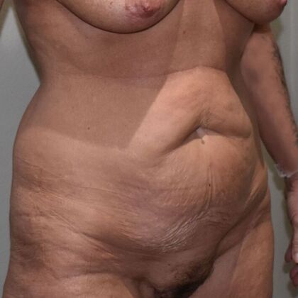 Tummy Tuck (Abdominoplasty): Case 525 - Before