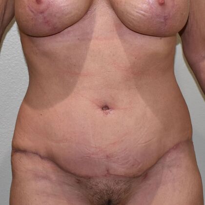 Tummy Tuck (Abdominoplasty): Case 525 - After