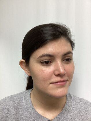 Ear Correction / Otoplasty: Case 5 (CID34610) - Before