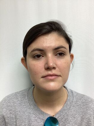 Ear Correction / Otoplasty Case 5 (CID34610) - Before