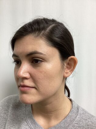 Ear Correction / Otoplasty: Case 5 (CID34610) - Before. Cup-like coutour of the ear.