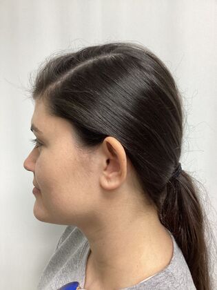 Ear Correction / Otoplasty: Case 5 (CID34610) - After. Rim out.