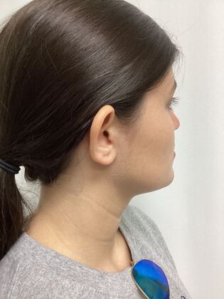 Ear Correction / Otoplasty: Case 5 (CID34610) - Before. Rim of ear projects toward camera.