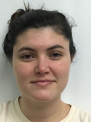 Ear Correction / Otoplasty Case 5 (CID34610) - After