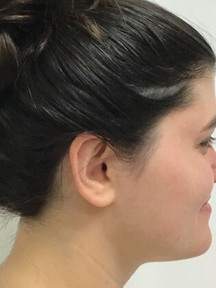 Ear Correction / Otoplasty: Case 5 (CID34610) - After. Rim now backward.