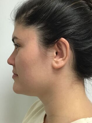 Ear Correction / Otoplasty: Case 5 (CID34610) - After. Rim back.