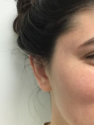 Ear Correction / Otoplasty: Case 5 (CID34610) - After