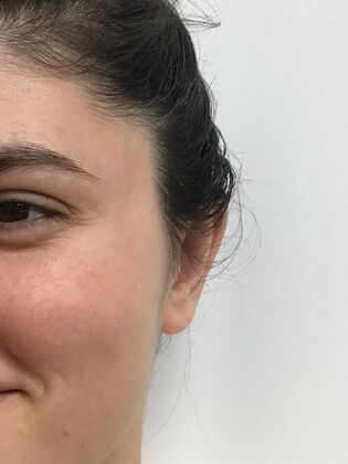 Ear Correction / Otoplasty: Case 5 (CID34610) - After. Natural contour.