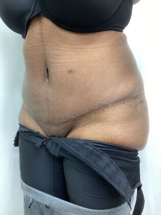 Body Tummy Tuck / Abdominoplasty: Case 27 (CID33941) - After, oblique