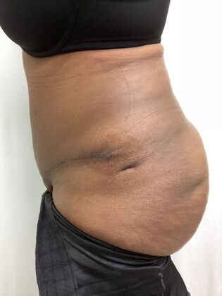 Body Tummy Tuck / Abdominoplasty: Case 27 (CID33941) - After, lateral