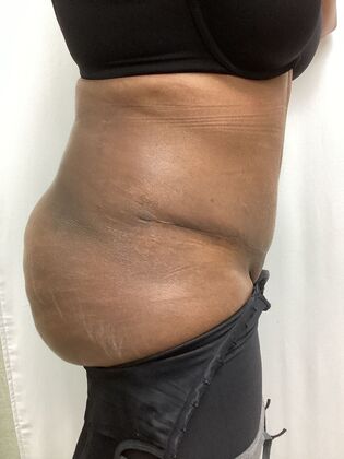 Body Tummy Tuck / Abdominoplasty: Case 27 (CID33941) - After, lateral.  Tummy flatter, lower back less curved.
