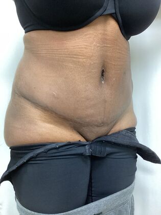 Body Tummy Tuck / Abdominoplasty: Case 27 (CID33941) - After, oblique