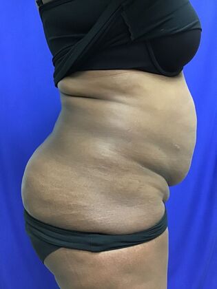 Body Tummy Tuck / Abdominoplasty: Case 27 (CID33941) - Before, lateral