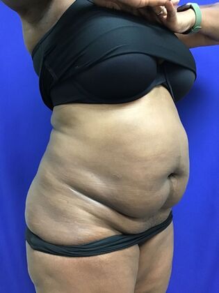 Body Tummy Tuck / Abdominoplasty: Case 27 (CID33941) - Before, oblique