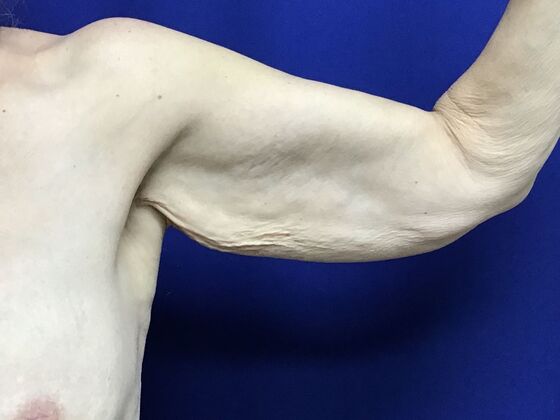 Arm Contouring / Lift: Case 9 (CID2905830) - Before