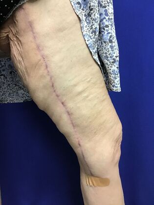 Arm Contouring / Lift: Case 9 (CID2905830) - After, left inner thigh
