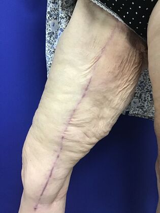 Arm Contouring / Lift: Case 9 (CID2905830) - After, right inner thigh