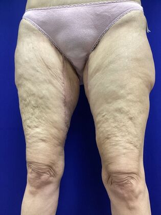 Thigh Reduction / Thighplasty: Case 2 (CID2905830) - After. Less lax skin. Better contour.