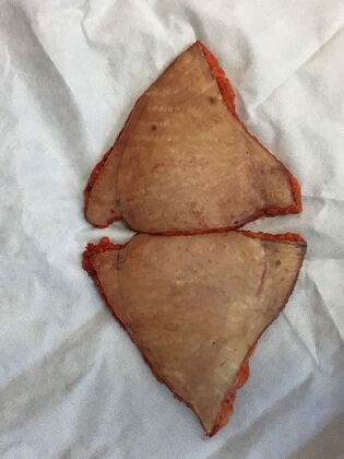 Body Tummy Tuck / Abdominoplasty: Case 28 (CID3177024) - Skin/Fat removed, two halves together. Belly button toward left, upper pubic excess toward right