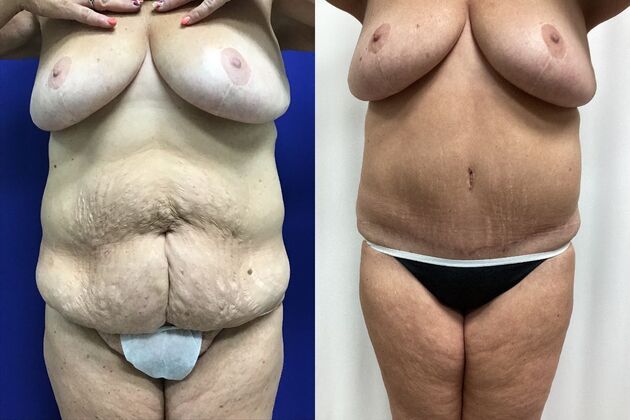 Body Tummy Tuck / Abdominoplasty Case 28 (CID3177024) - Before