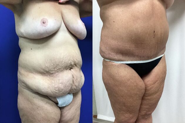 Body Tummy Tuck / Abdominoplasty Case 28 (CID3177024) - After