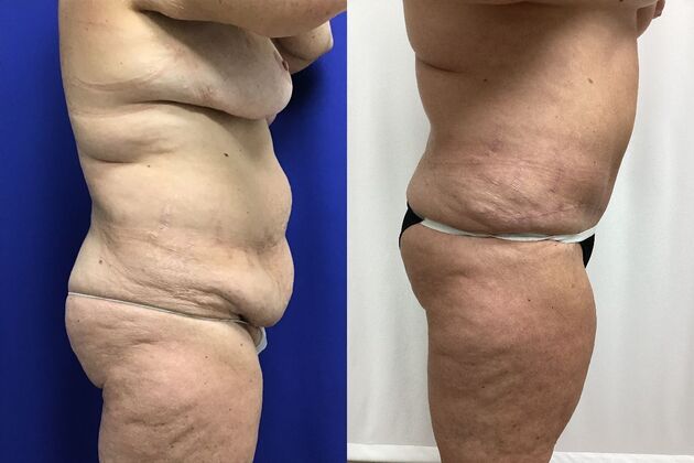 Body Tummy Tuck / Abdominoplasty: Case 28 (CID3177024) - B&A, lateral