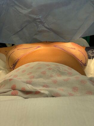 Breast Lift / Mastopexy: Case 43 (CID2491591) - Before.  Implants shift to the sides while lying down.