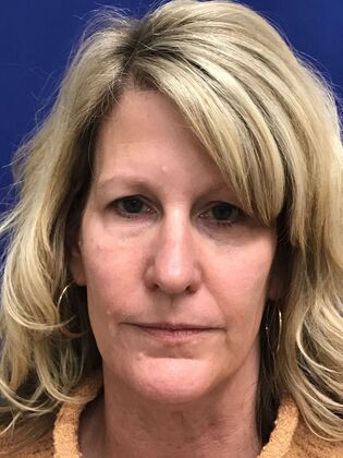 Facial Eyelid Surgery / Blepharoplasty: Case 16 (CID841706) - Before, hooding upper folds