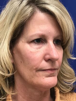 Facial Eyelid Surgery / Blepharoplasty: Case 16 (CID841706) - Before, hooding and lower bags