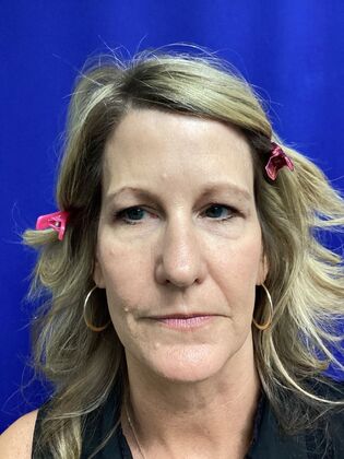 Facial Eyelid Surgery / Blepharoplasty Case 16 (CID841706) - Before