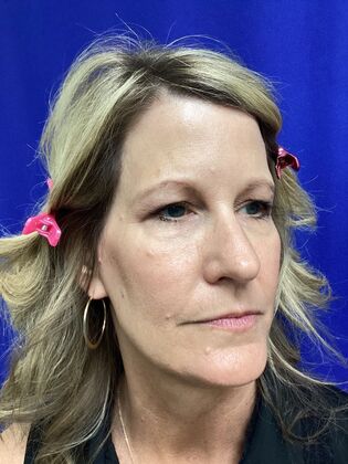 Facial Eyelid Surgery / Blepharoplasty: Case 16 (CID841706) - Before