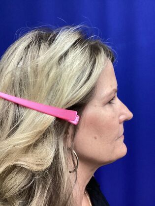 Facial Eyelid Surgery / Blepharoplasty: Case 16 (CID841706) - Before