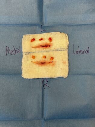 Facial Eyelid Surgery / Blepharoplasty: Case 16 (CID841706) - Surgical specimens, skin (upper), fat pads (lower)