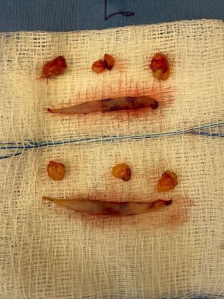 Facial Eyelid Surgery / Blepharoplasty: Case 16 (CID841706) - Skin and fat removed