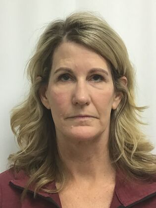 Facial Eyelid Surgery / Blepharoplasty Case 16 (CID841706) - After