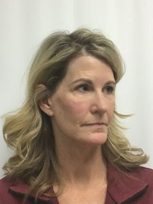 Facial Eyelid Surgery / Blepharoplasty: Case 16 (CID841706) - After