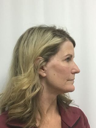 Facial Eyelid Surgery / Blepharoplasty: Case 16 (CID841706) - After