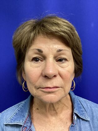 Facial Facelift / Necklift Case 27 (CID43393296) - Before