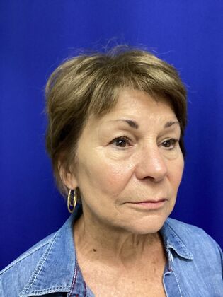 Facial Facelift / Necklift: Case 27 (CID43393296) - Before