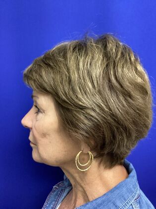 Facial Facelift / Necklift: Case 27 (CID43393296) - Before