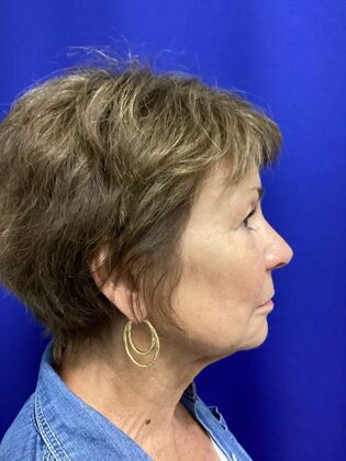 Facial Facelift / Necklift: Case 27 (CID43393296) - Before