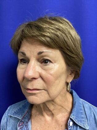 Facial Facelift / Necklift: Case 27 (CID43393296) - Before