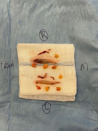 Facial Facelift / Necklift: Case 27 (CID43393296) - Eyelid specimens, skin portions upper and lower, lower fat pads
