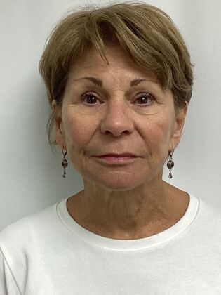 Facial Facelift / Necklift Case 27 (CID43393296) - After