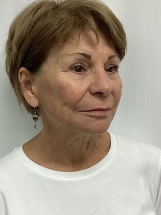 Facial Facelift / Necklift: Case 27 (CID43393296) - After