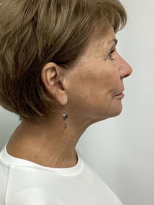 Facial Facelift / Necklift: Case 27 (CID43393296) - After