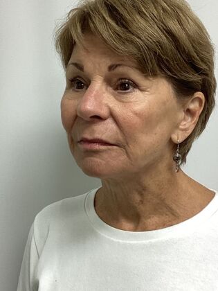 Facial Facelift / Necklift: Case 27 (CID43393296) - After