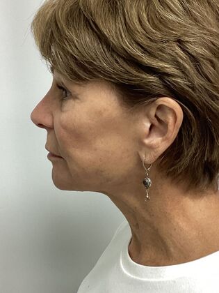 Facial Facelift / Necklift: Case 27 (CID43393296) - After