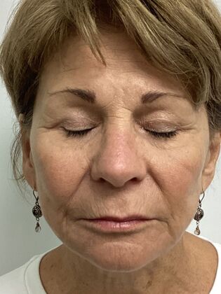 Facial Facelift / Necklift: Case 27 (CID43393296) - Post-op eyelid scar locations