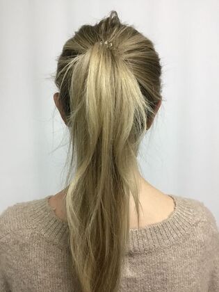 Ear Correction / Otoplasty Case 6 (CID491370) - After